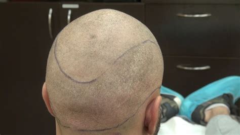 Fue Hair Transplant Scar After Two Hair Restoration Surgery By Dr Diep