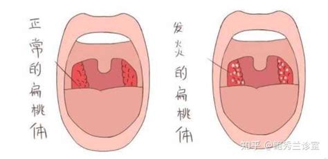 孩子扁桃体炎又犯了，到底切还是不切？ 知乎