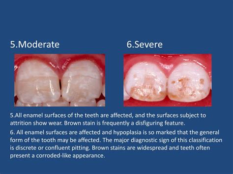 Ppt Dental Fluorosis Powerpoint Presentation Free Download Id2256165