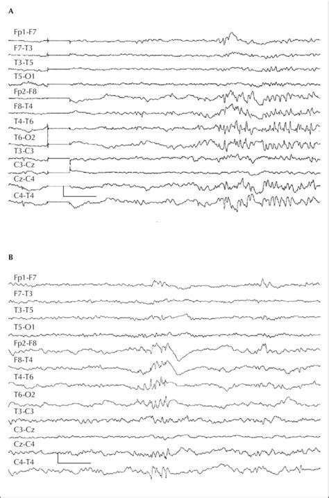 Interictal Eeg Recording Of The Patient Illustrates The Epileptic