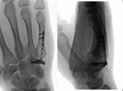 Open Reduction And Internal Fixation Of The 5th Carpometacarpal Joint With Bridging Plate Using
