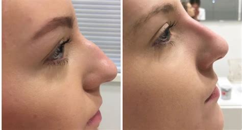 Non Surgical Nose Job What You Need To Know Before Getting One In