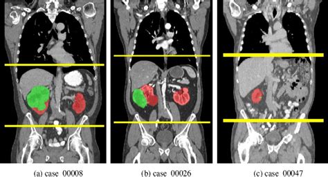 Figure 1 From Segmentation Of Kidney And Renal Tumor In Ct Scans Using