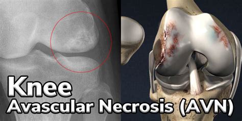 Knee Avascular Necrosis Dr Lox Sports Regenerative Medicine