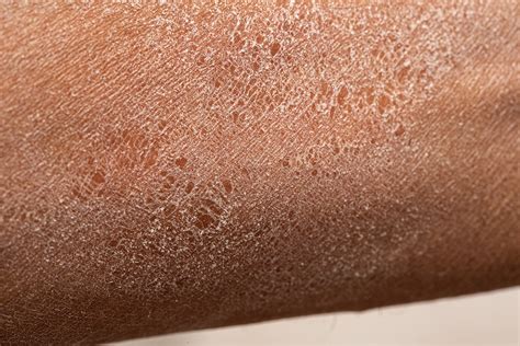 6 Causes Of Dry Patches On Your Skin And What To Do Iwi Life