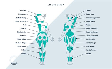 Posted by anonymous on feb 07, 2014. Where You Can Use Liposuction On The Body - Chart Attack