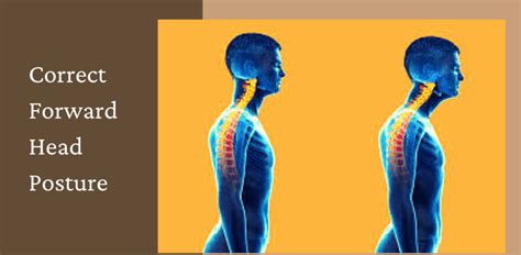 Correct Forward Head Posture To Have A Healthy Body Posture Guides