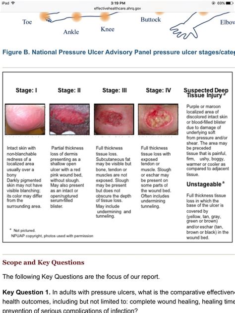 Staging Decubitus Ulcers Pressure Ulcer Pressure Ulcer Staging Images