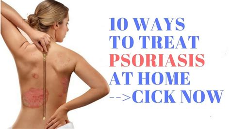 10 Ways To Treat Psoriasis At Home How To Treating Plaque Psoriasis Youtube