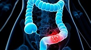 Research and Treatment for Colorectal Cancer - Trybiotech