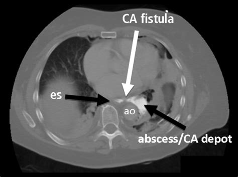 A Computed Tomography Ct Scan With Oral Contrast Agent Ca Revealed