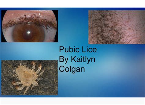 Pubic Lice By Kaitlyn Colgan Screen 11 On Flowvella Presentation Software For Mac Ipad And