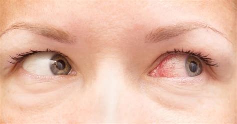 Why is my smoke detector beeping intermittently? How Long Does Pink Eye Last: Symptoms, Treatment ...