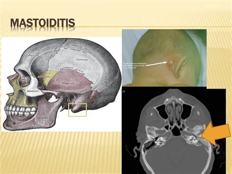 Ppt Otorhinolaryngology Disorders Of The Ear Nose And Throat