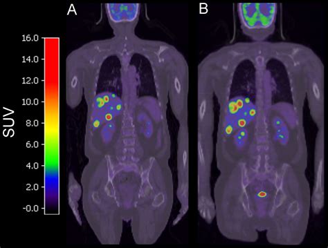 Repeatability Of Metabolically Active Tumor Volume Measurements With