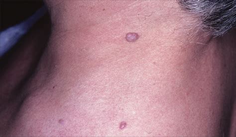 Multiple Eruptive Angiomatous Lesions In A Patient With Multiple