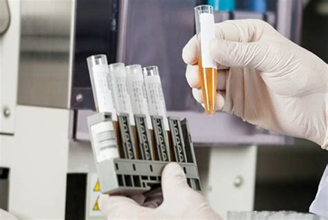 Non Invasive Test Detects Bladder Cancer Tech Briefs