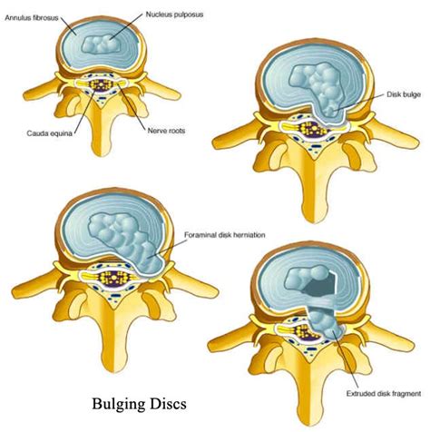 Bulging Disc In Neck Painful Spine Conditions In The Neck