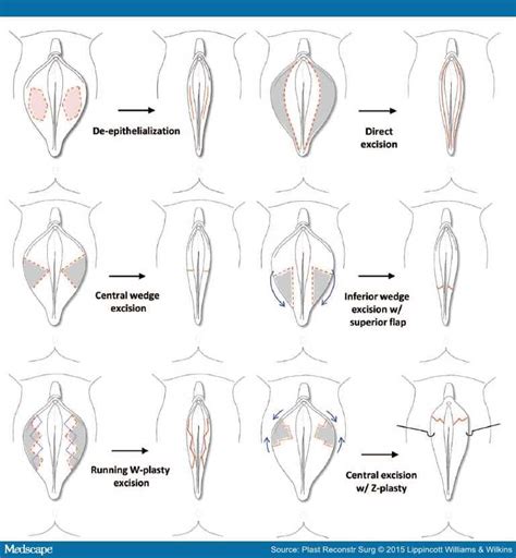 Vaginal Labiaplasty