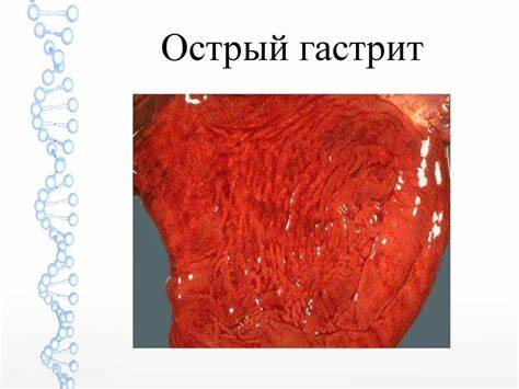 Острый гастрит диеты Патология желудка - презентация онлайн Патология желудка - презентация онлайн Острый гастрит диеты