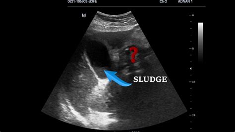 Emergency Ultrasound In Right Upper Quadrant Pain Case 1 Youtube
