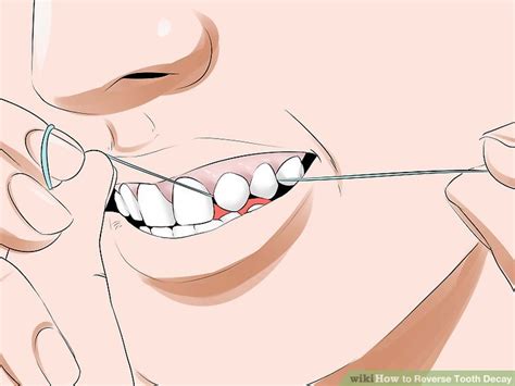 You can awaken the power within yourself to heal your body from just about anything. 3 Ways to Reverse Tooth Decay - wikiHow