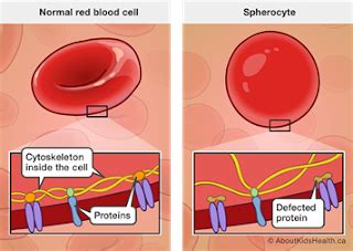 It is a result of heterogeneous alterations in one of five genes that encode red blood cell (rbc) membrane proteins involved in vertical associations that link the membrane cytoskeleton to the lipid bilayer. Hereditary spherocytosis