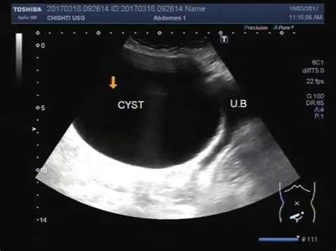 Large Ovarian Cyst Ultrasound
