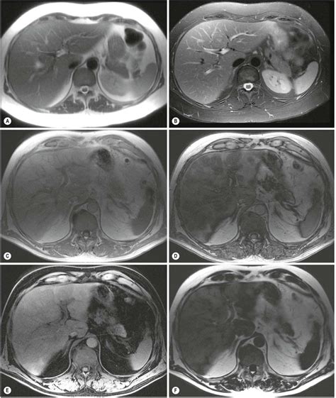 The Liver And Spleen Radiology Key