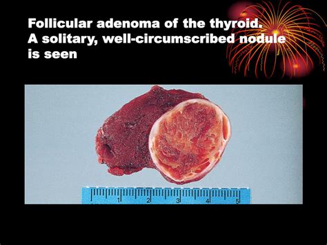 Ppt Solitary Nodule Of Thyroid Powerpoint Presentation Free Download