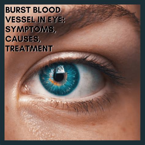 Burst Blood Vessel In Eye Symptoms Causes Treatment Youmemindbody