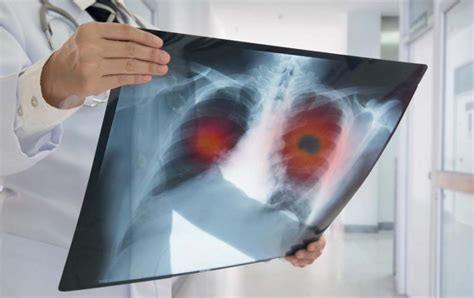 Lung Cancer Types Signs Symptoms Diagnosis And Treatment