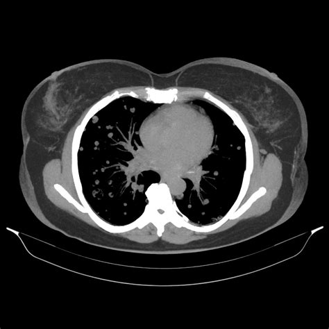 Chest Ct Scan Images Dataset Kaggle