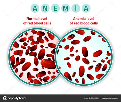 Anemia Level Of Blood Cells Stock Vector Image By ©annyart 200393022