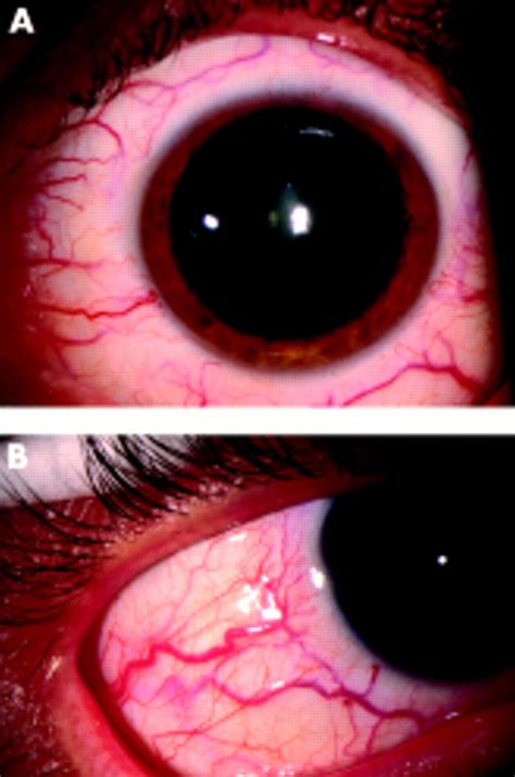 Idiopathic Dilated Episcleral Veins And Increased Intraocular Pressure