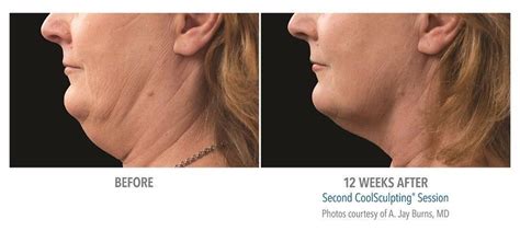 Get Rid Of Your Double Chin Chin Fat Reduction Los Angeles La Ca