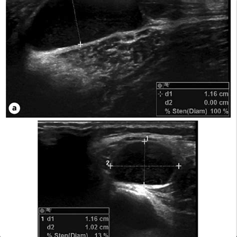 Postoperative Ultrasound Images Of The Peroneal Nerve At The Resection