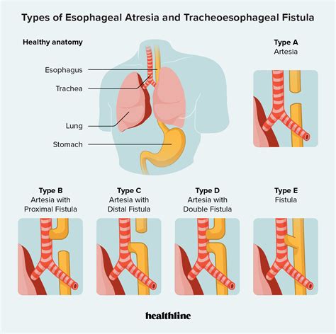 Tracheoesophageal Fistula Esophageal Atresia Trachea Dysphagia The