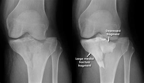 Trauma X Ray Lower Limb Gallery 1 Knee Tibial Plateau Fractures
