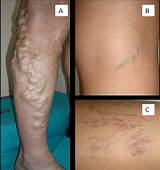 Images of Doctor Para Varices