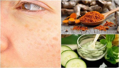 5 Home Remedies To Treat Age Spots Naturally Daily Health Valley