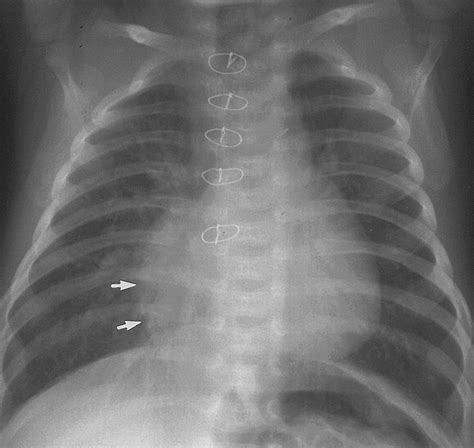 Hypoplastic Left Heart Syndrome Radiographics