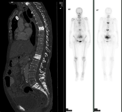 Bone Metastases Ct And Bone Scan Radiology At St Vincents