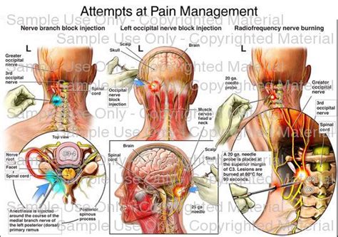 Occipital Neuralgia Attempts At Pain Management Occipital Neuralgia
