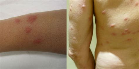 Luckily, there are many easy home remedies for bug bites. How to heal mosquito bites scars - THAIPOLICEPLUS.COM
