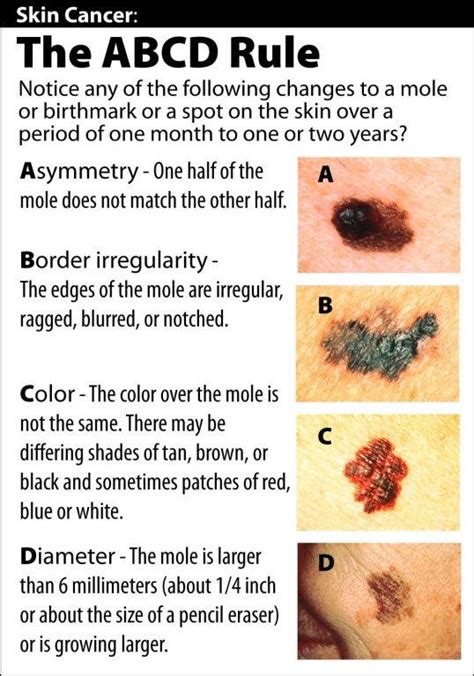 Mole Check Know Your Abcds Upper Dublin Pa Patch