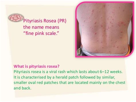 Pityriasis Rosea Chest
