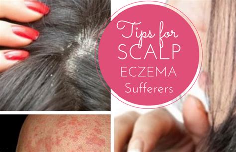Tips For Effectively Managing And Minimising Symptoms Of Scalp Eczema