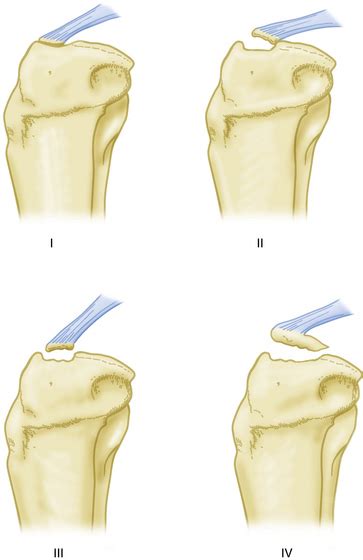 Arthroscopic Management Of Tibial Plateau Fractures Musculoskeletal Key