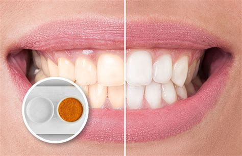 Die bleaching streifen sorgen dafür, dass du wieder weiße zähne bekommst. Geheimtipp: Diese zwei Hausmittel machen deine Zähne ...